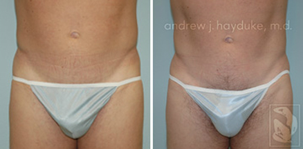 lipo 09