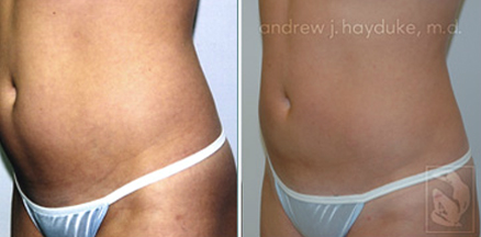 lipo 06