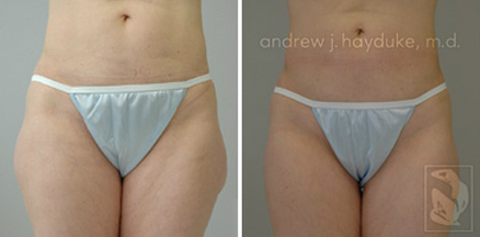 lipo 34