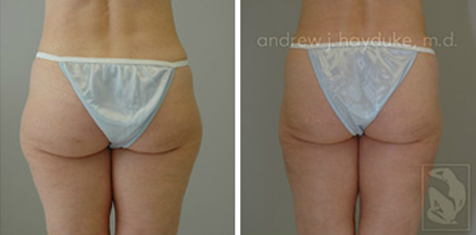 lipo 35