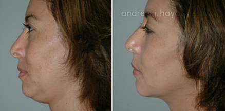 lipo 54