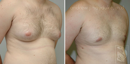 lipo 61