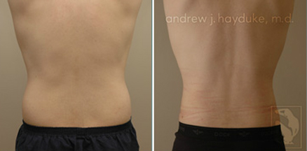 lipo 92
