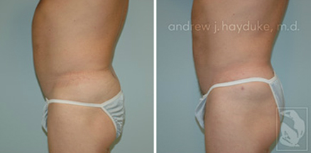 lipo 08