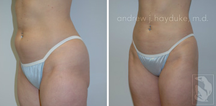 lipo 12