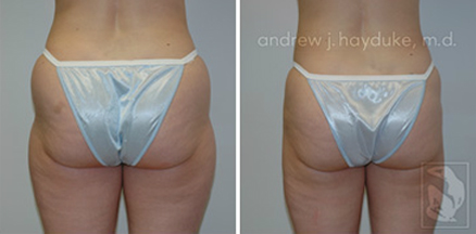 lipo 14