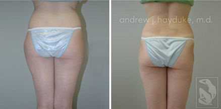 lipo 31