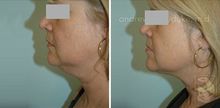 lipo 15