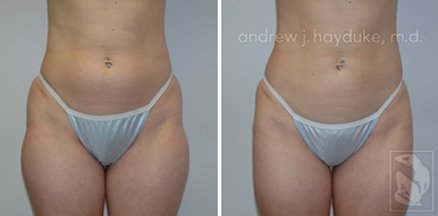 lipo 20